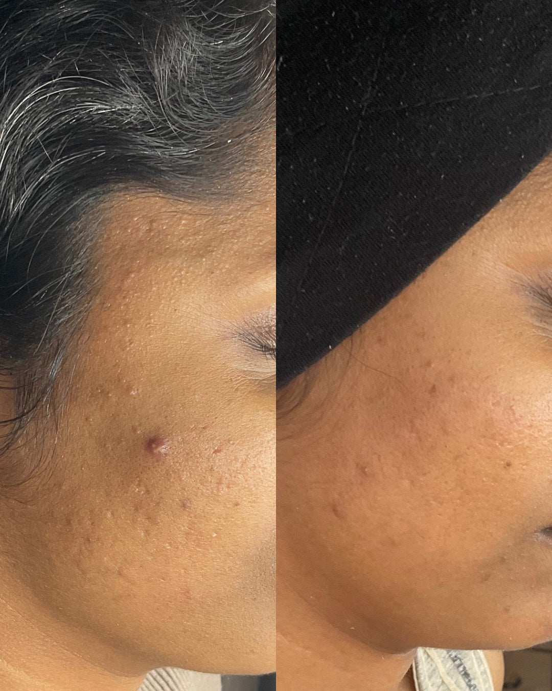 Before and after comparison of a person's forehead with visible skin texture and blemishes.