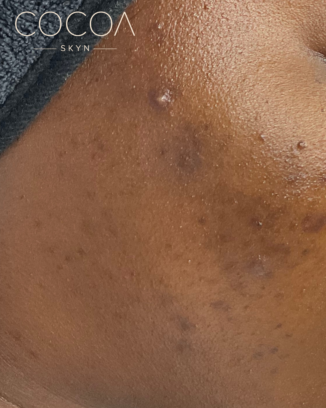 How to Fade Stubborn Dark Marks Without Damaging Your Skin Barrier