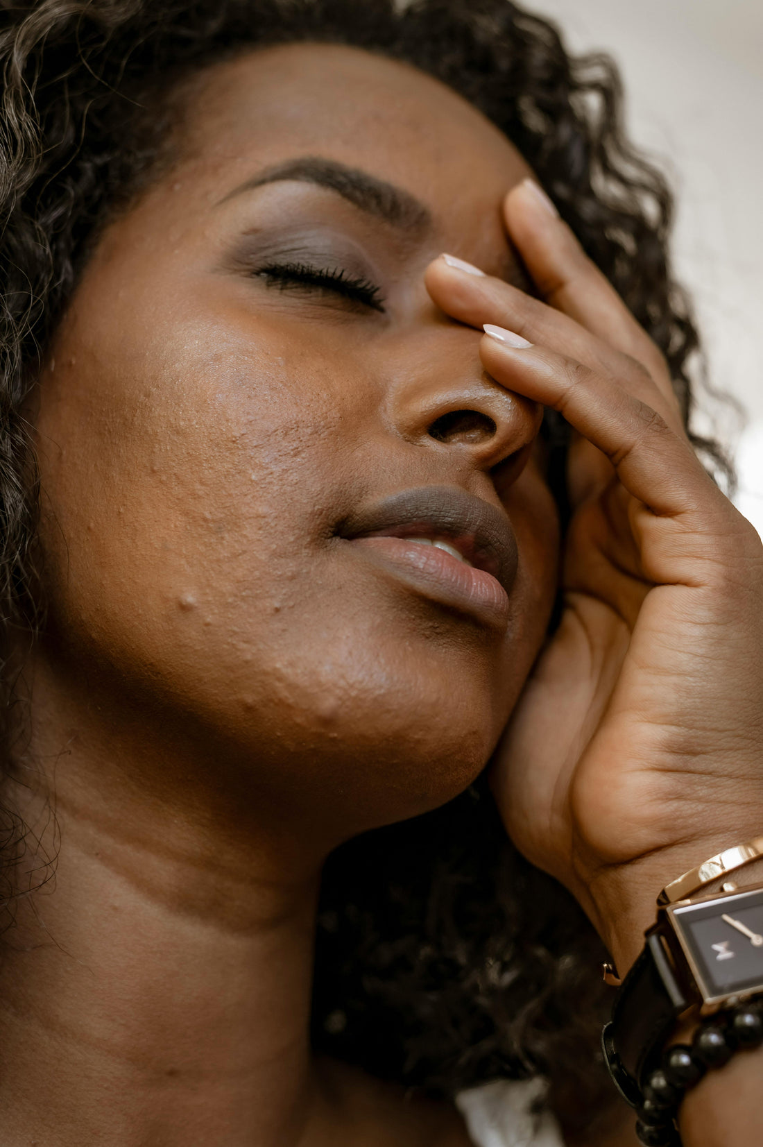 Hyperpigmentation treatment for skin of color