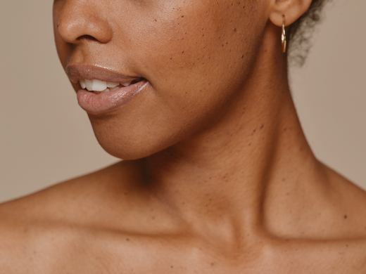 Melasma vs. Hyperpigmentation: What's the Difference?