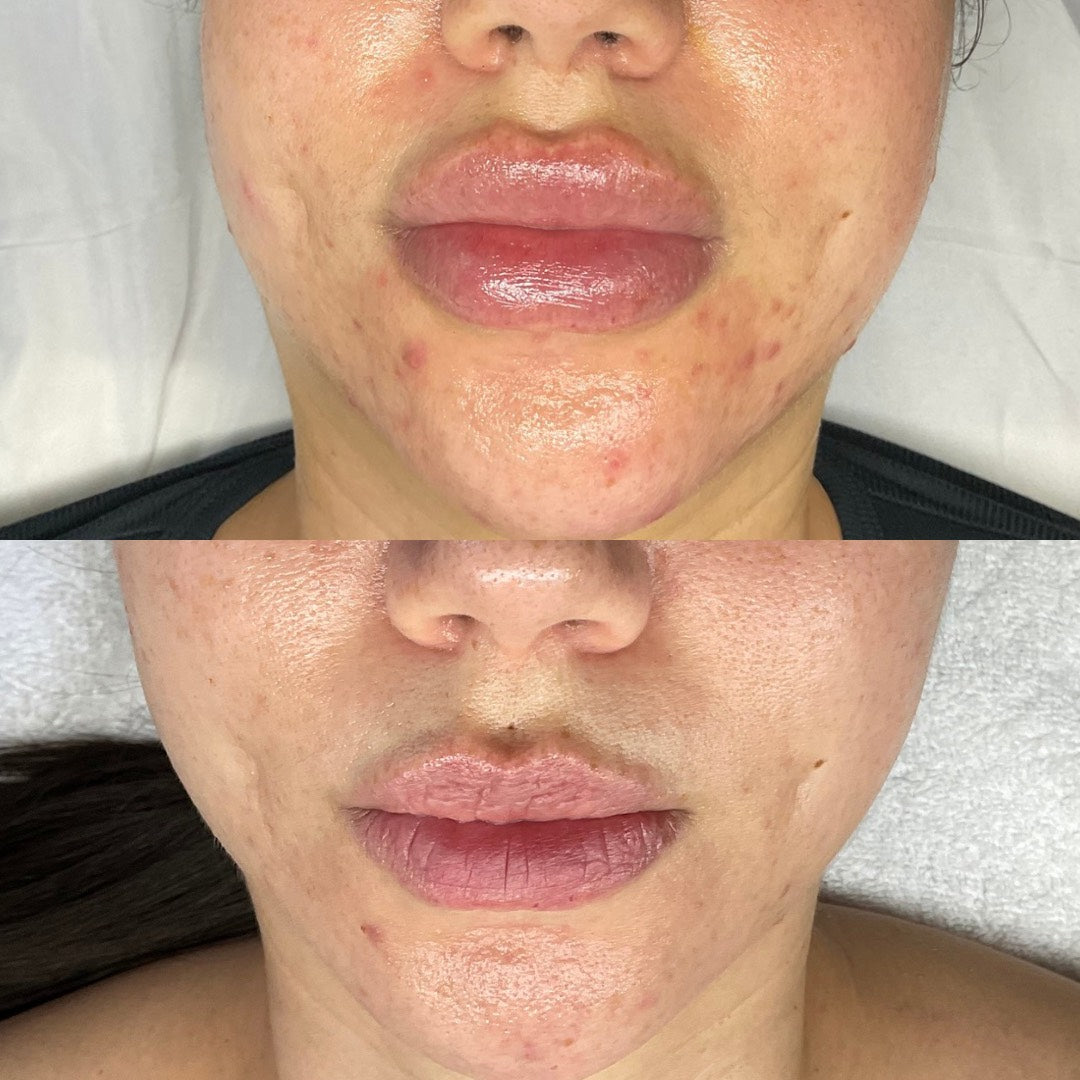 Before and after comparison of a person's face with visible acne on the top half and clearer skin on the bottom half.