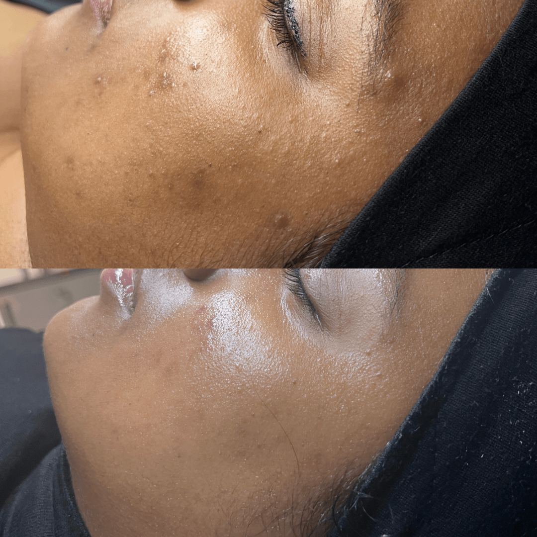 Acne Treatment Before & After